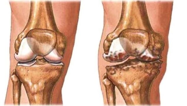здрава артроза на колената и колената
