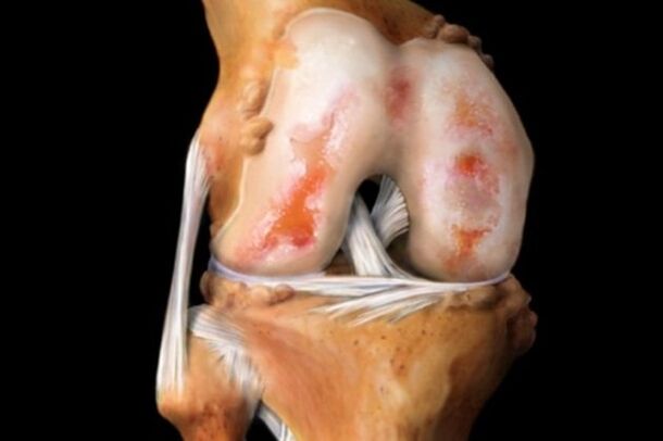 оштетување на 'рскавицата при артроза на колената