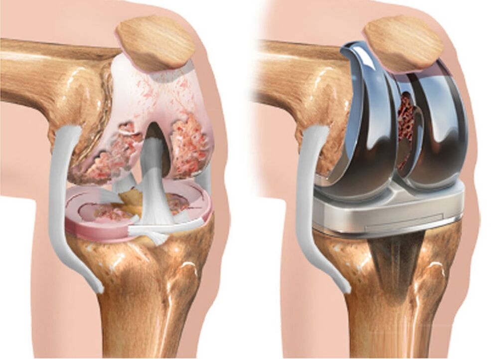 пред и по артроза на коленото зглоб за артроза