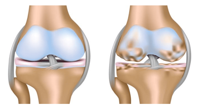 здрава 'рскавица и оштетување на коленото зглоб со артроза