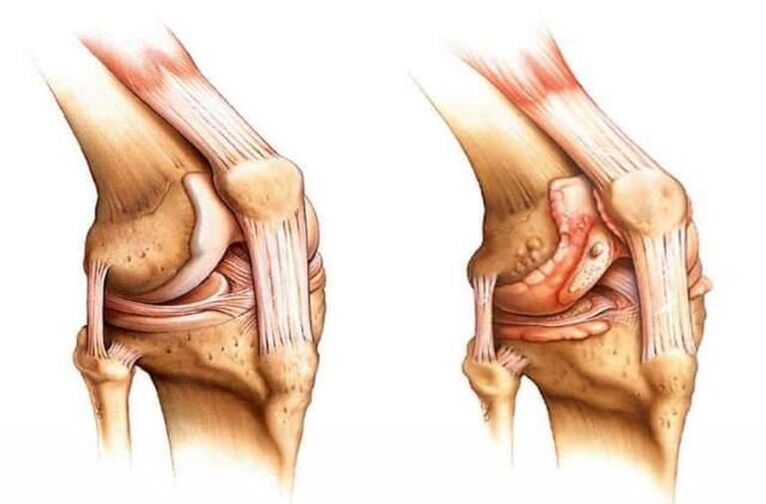здраво колено и артроза на коленото зглоб