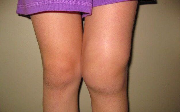 отечен зглоб на коленото поради остеоартритис