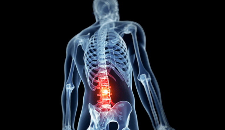 лезија на лумбалниот 'рбет кај остеохондроза