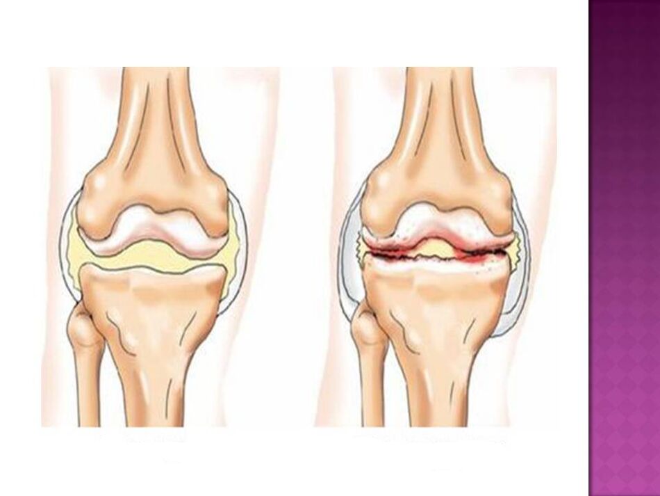 Зглобот е нормален (лево) и погоден од остеоартритис (десно)