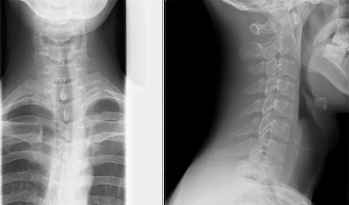 Рентгенот на 'рбетот е едноставен и ефикасен метод за дијагностицирање на остеохондрозата
